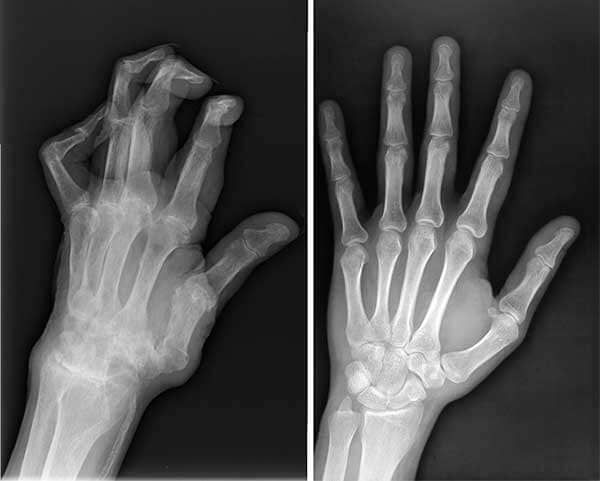 Radiografía de mi esposo antes y después de usar Ultravix